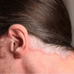 scalp psoriasis