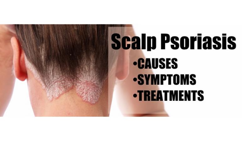 What causes scalp psoriasis? - Plaque Psoriasis - Sharecare