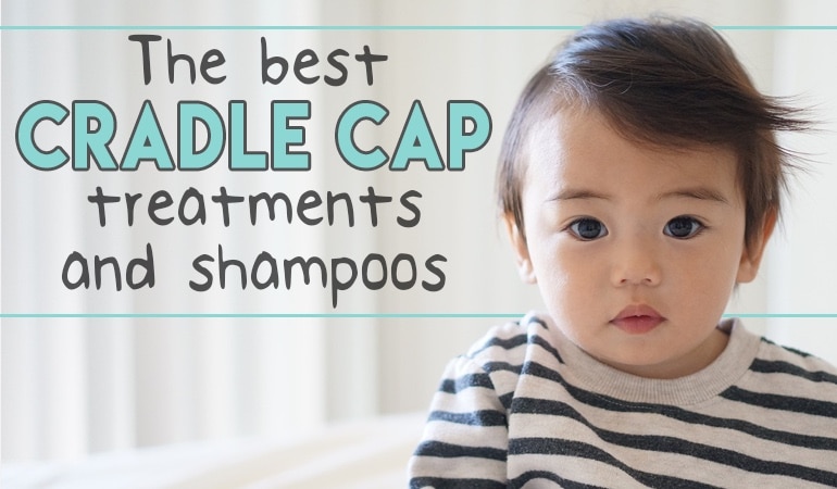 cradle cap cure baby