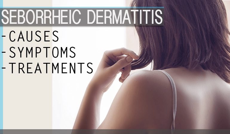 how to treat seborrheic dermatitis